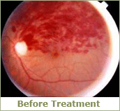 branch retina before treatment