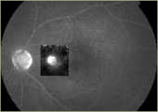 Central Serous Retinopathy initial stage