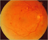 Central Serous Retinopathy healed stage