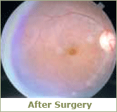 after surgery