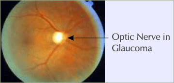 optic nerve in glaucoma