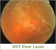 HST post laser