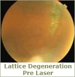 lattice pre laser