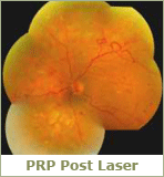 prp post laser