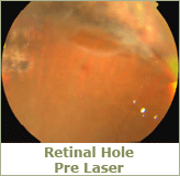 retinal hole pre laser
