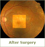 Macular Hole After Surgery