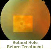 RATINAL HOLE BEFORE TREATMENT