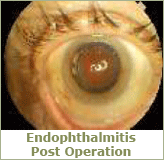 Endophthalmitis post operation